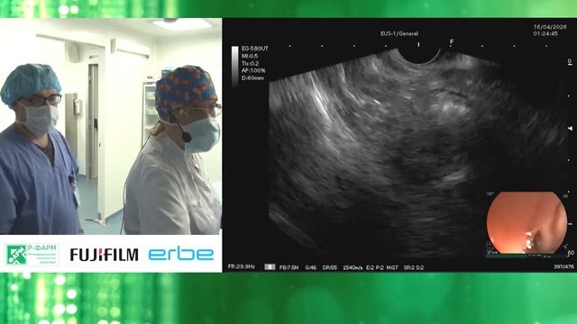 Эрдосонография с тонкоигольной пункцией ГИСО с одномоментной петлевой резекцией аденомы желудка