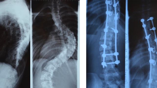 Хирургическое лечение сколиоза 4 степени. Отзывы пациентов