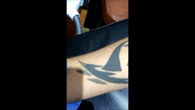 Удаление татуировки лазером в Брянске. Без ожогов и рубцов.