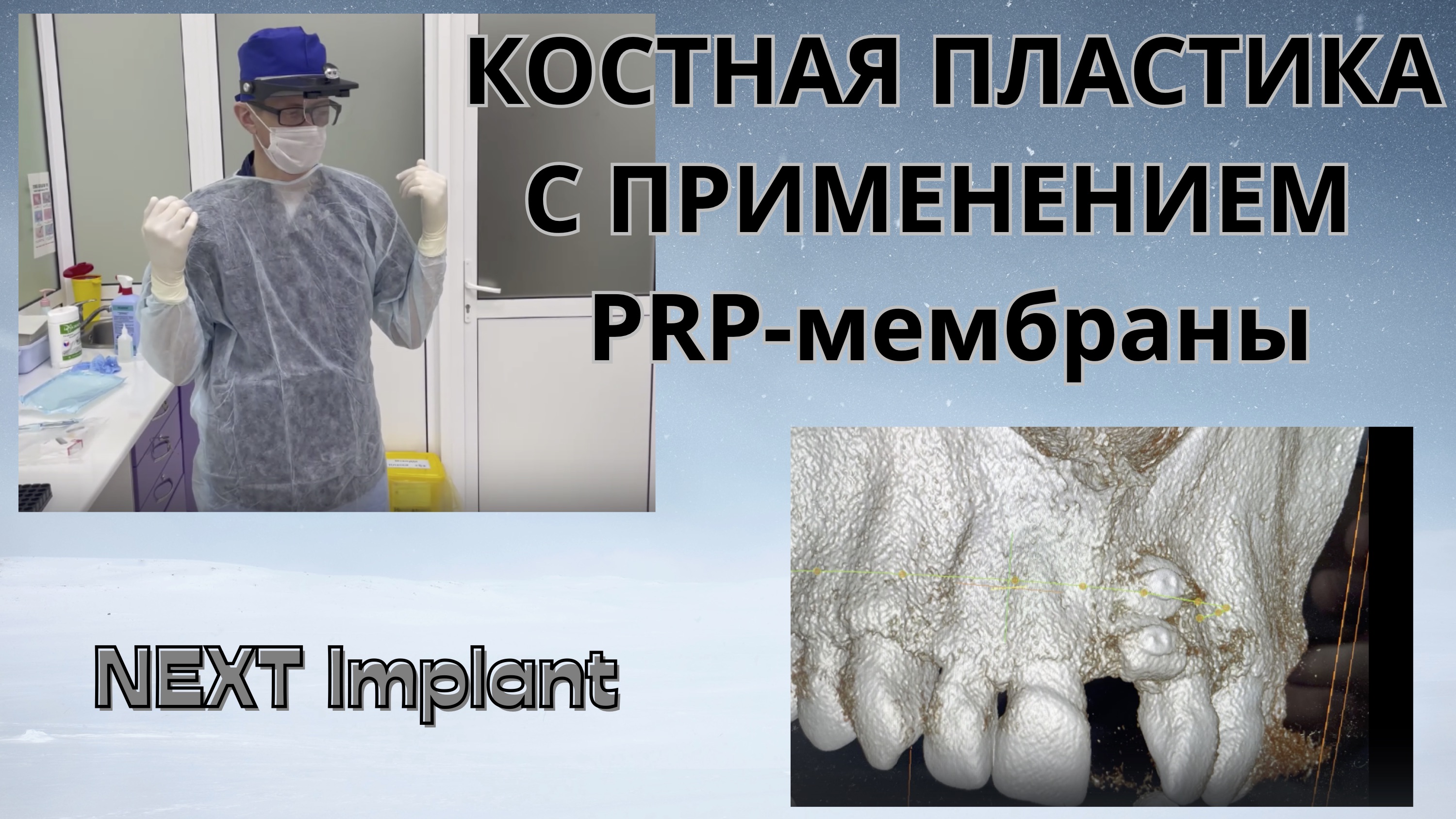 Костная пластика, установка имплантата на верхней челюсти с применением PRP-мембраны.