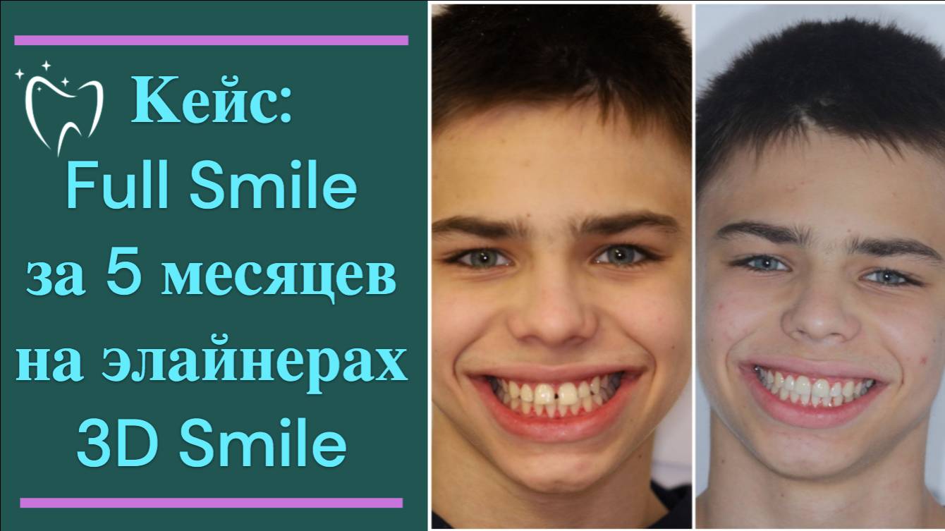 💎 Кейс: исправление прикуса на элайнерах 3D Smile за 5 месяцев