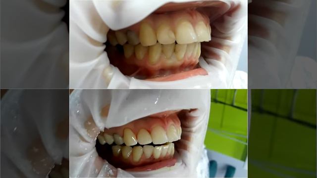 Лечение передних зубов Харьков