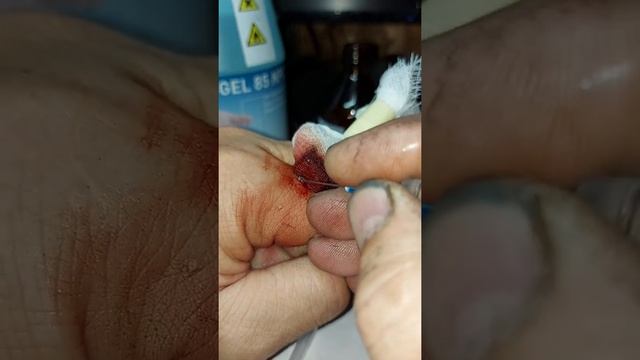 Часть 2. Как избавится от металлического осколка из руки в домашних условиях.02.08.2022 год.