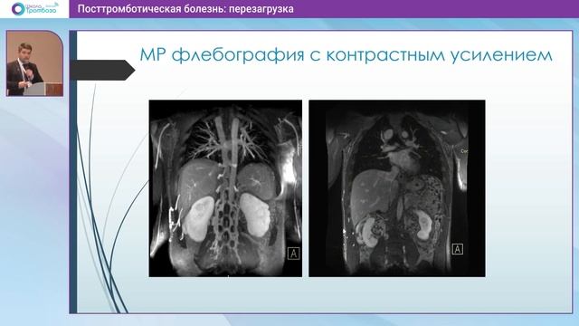 Доклад Особенности лучевой диагностики ПТБ: место КТ и МРТ флебографии 17.06.2023