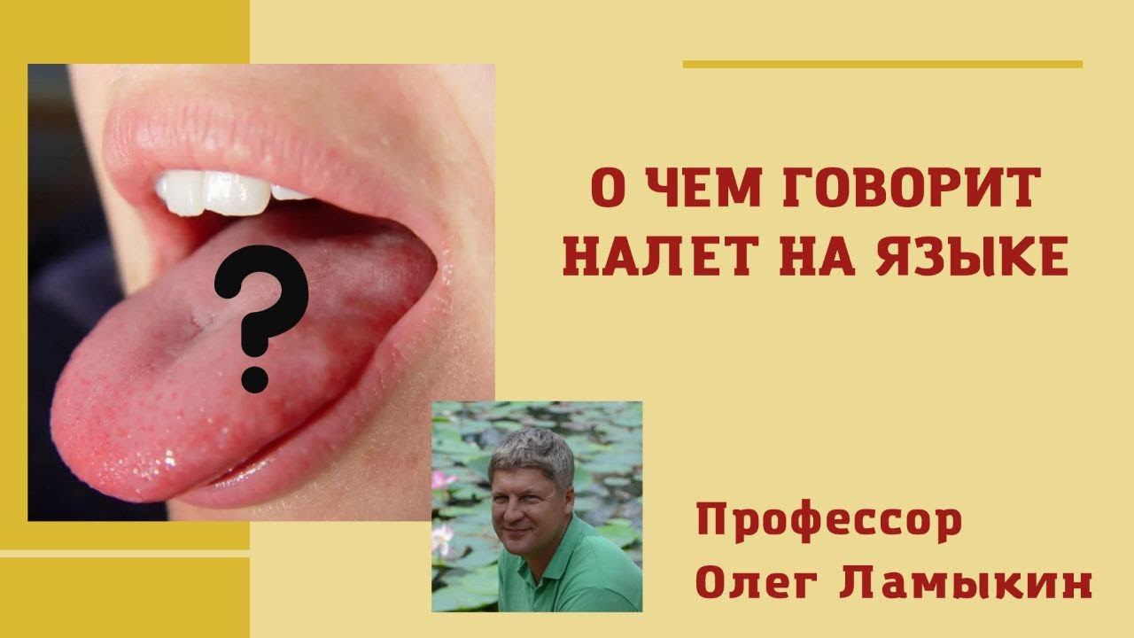 О чем говорит налет на языке? Проф. Ламыкин О.Д.