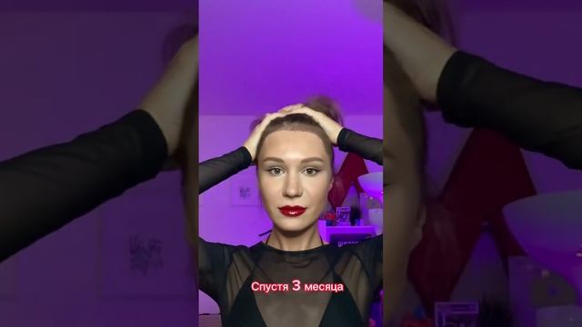 Зачем мне пересадили волосы на ЛОБ? ? #пересадкаволос