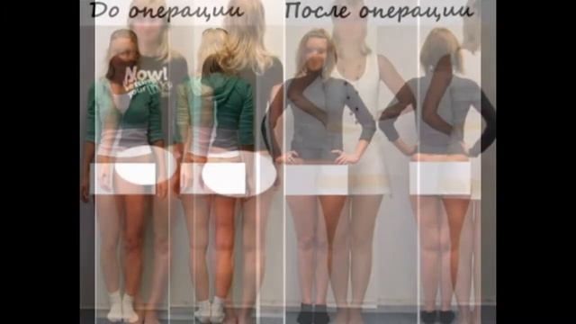 ХИРУРГИЧЕСКОЕ ИСПРАВЛЕНИЕ КРИВИЗНЫ НОГ