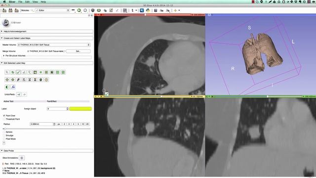 Segmentation of lung and nodule in CT using 3D Slicer