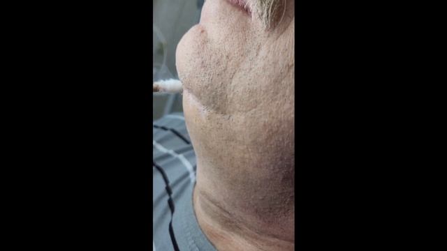 Криодеструкция папиллом на шее