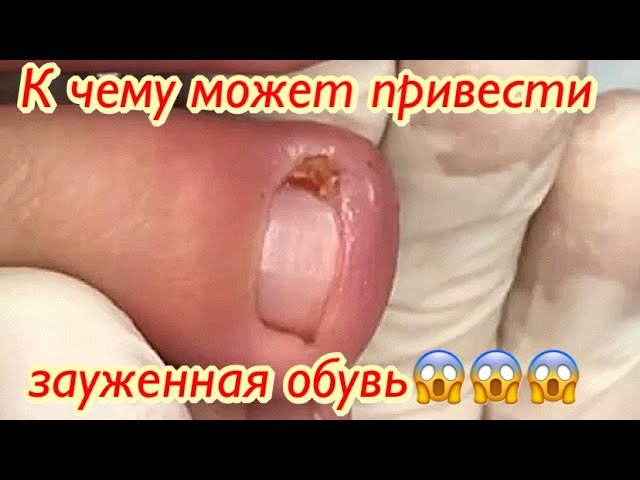 К чему может привести зауженная обувь