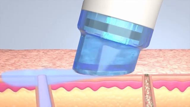 Аппаратная косметология   HydraFacial