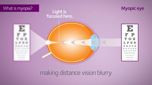 MiSight Contact Lenses for Myopia Control