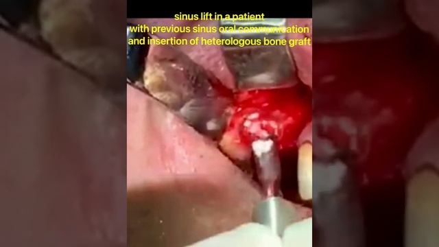 Sinus lift in patient with   previous oral-sinusal communication. Dr. Dus