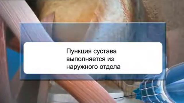 Остеартроз. Видео 1 - СпортКлиника