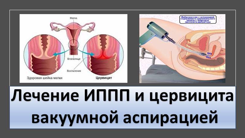 Лечение цервицита и ИППП вакуумной аспирацией