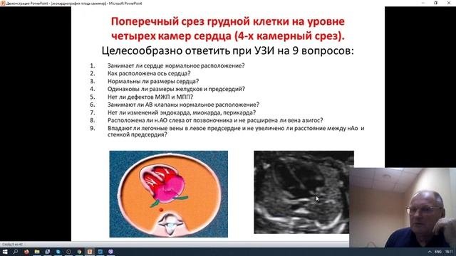 Пороки сердца  плода