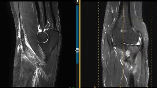 72 year old male with elbow pain from torn biceps tendon