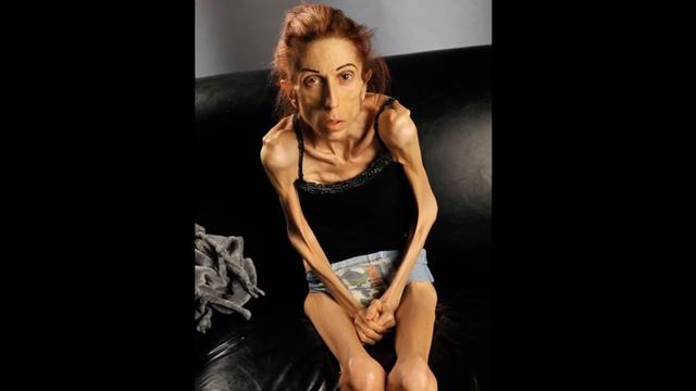 ИСТОРИЯ АНОРЕКСИИ Рэйчел Фаррух/Любопытные факты
