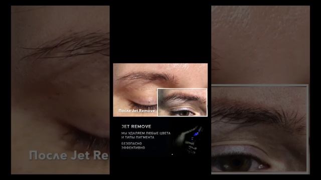 Чистая кожа вместо Красных бровей, удалили ремувером Jet Remove в Санкт-Петербурге