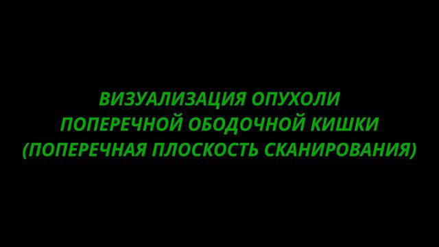 Эндофитный рак кишки IV ст. (УЗИ-картина)