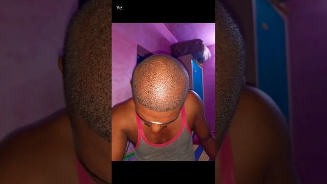Amazing 2 Month Hair Transplant Results ??? #ameerht #hairtransplanttamil  #tamilhairtransplant