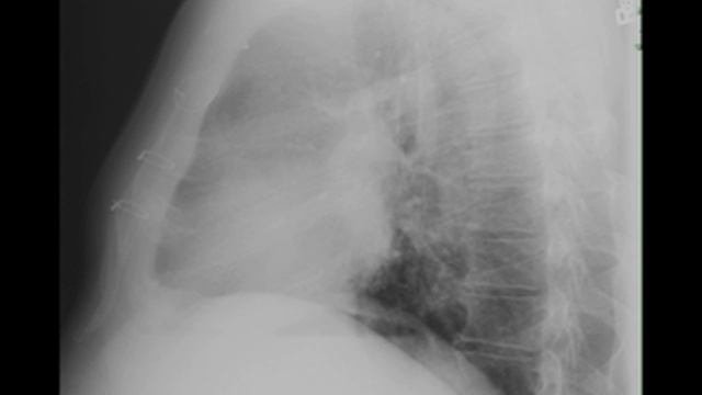 Hilar Adenopathy on Chest X ray