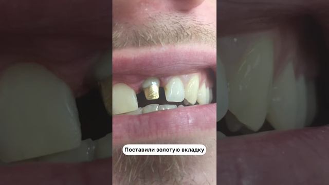 Восстановление зуба коронкой в клинике Золотарёва