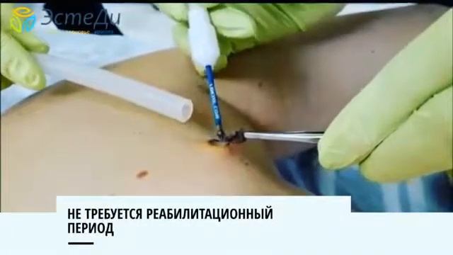 Удаление новообразований радиоволновым методом в клинике «Эстеди»