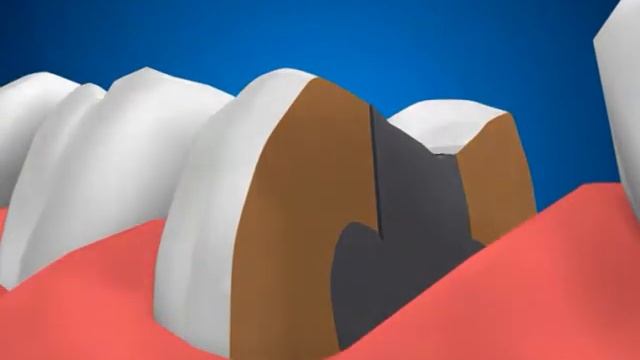 Механизм откола стенок зуба