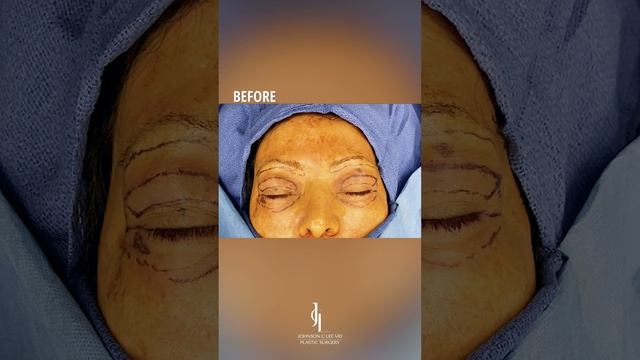 Eyelid Surgery Before & After | Dr. Johnson C. Lee | Beverly Hills, CA