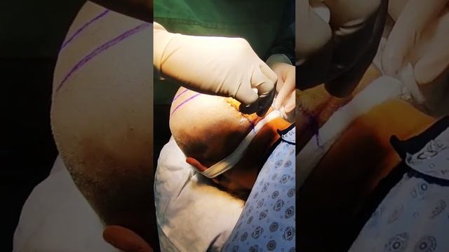 Обезболивание перед трансплантацией волос в @hairneva_hairtransplant #viral #turkey #shorts