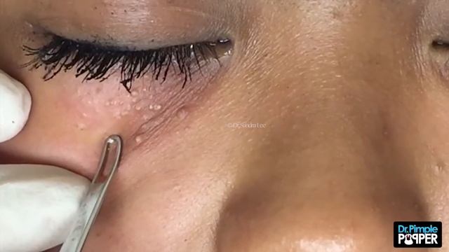 Multiple milia under the eyes