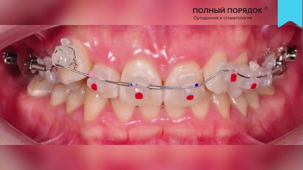 Прогресс за 4 месяца при лечении индивидуальной комбинированной брекет-системой INSIGNIA