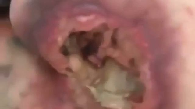 Страшные пролежни у женщины в больнице