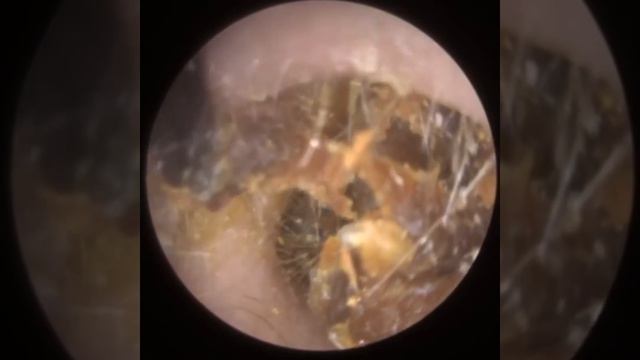 766 - Severely Retracted Eardrum Ear Wax Removal