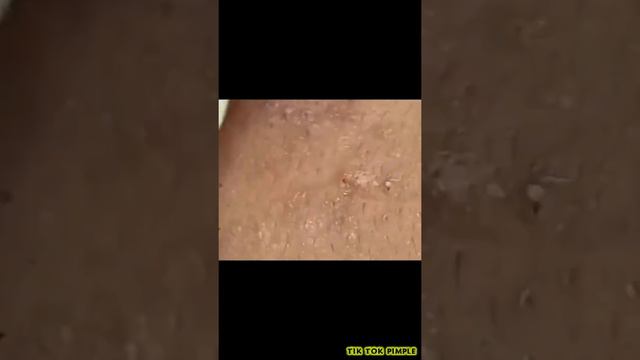 1 TIK TOK PIMPLE VIDEO COMPILATION US UK  21st August 2020