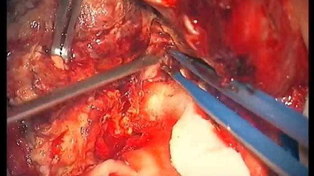 Глиобластома правой височной доли / Right temporal glioblastoma