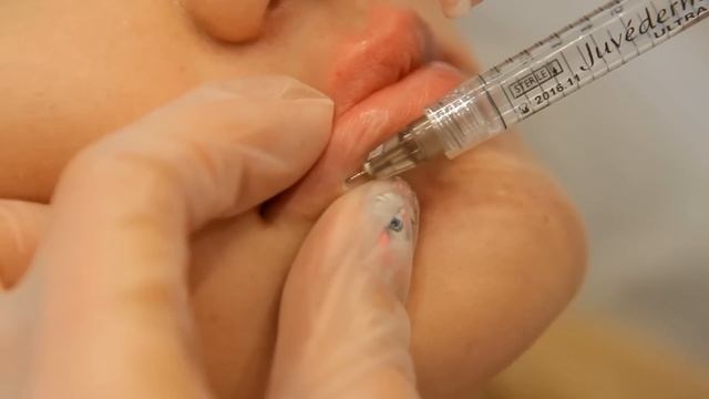 Увеличение губ Juvederm Ultra 3.