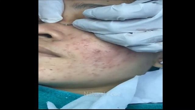удаление угрейRemove blackhead part3