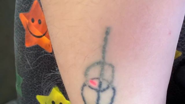 Удаление татуировки лазером в Брянске