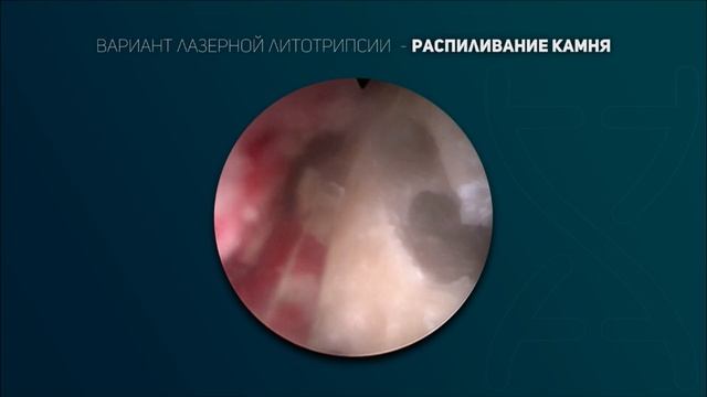 Лазерная литотрипсия. Видео 2.