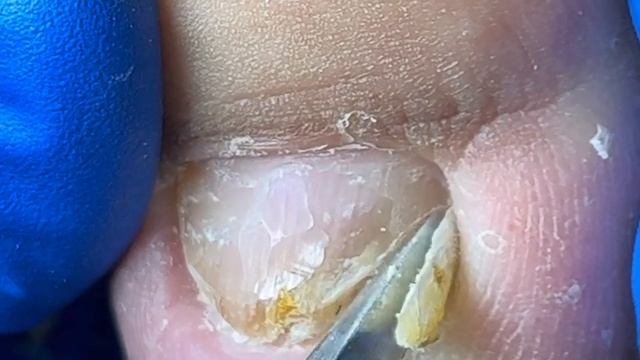 Nail trim: Doctor uses a knife to dig out a piece of bent nail【Xue Yidao Pedicure】