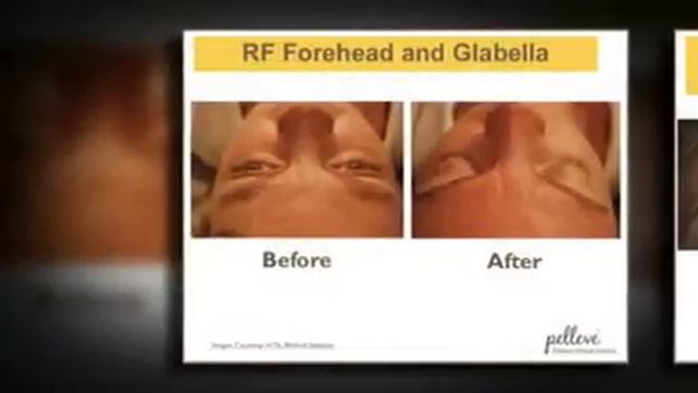 Pelleve before and after by Dr. Michael Stampar