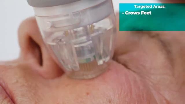 Vivace RF Microneedling Demo