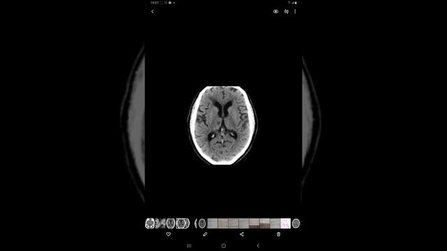 A thalamic infarct...