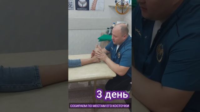 Вывих костей стопы. Коррекция стопы.