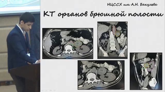 Круглый стол 1. Юсуфоф М.П., Случай успешного лечения феохромоцитомы у пациента .. .