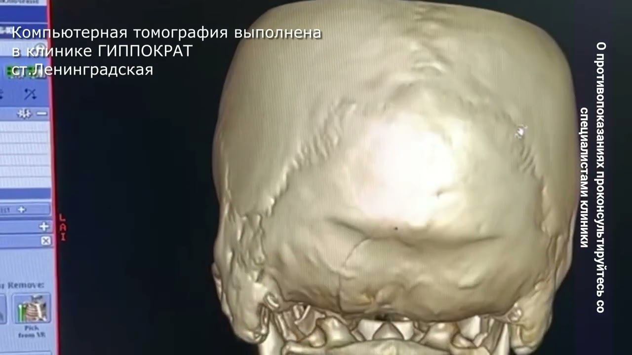 Перелом черепа. Компьютерная томография в станице Ленинградской в клинике Гиппократ