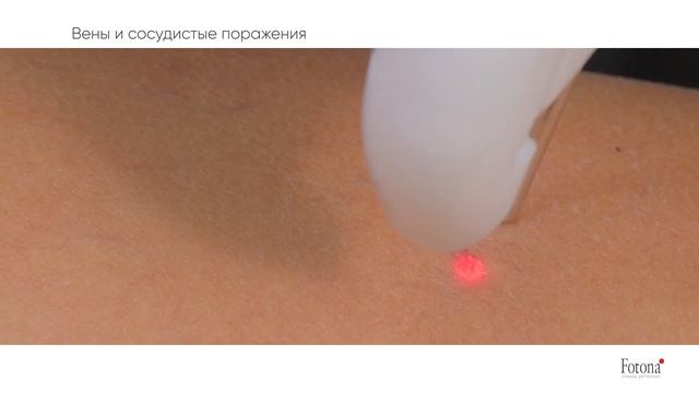 Вены и сосудистые поражения. Fotona