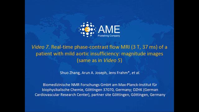 Asvide: Real-time phase-contrast flow MRI (3 T, 37 ms) of a patient with mild aortic insufficiency.
